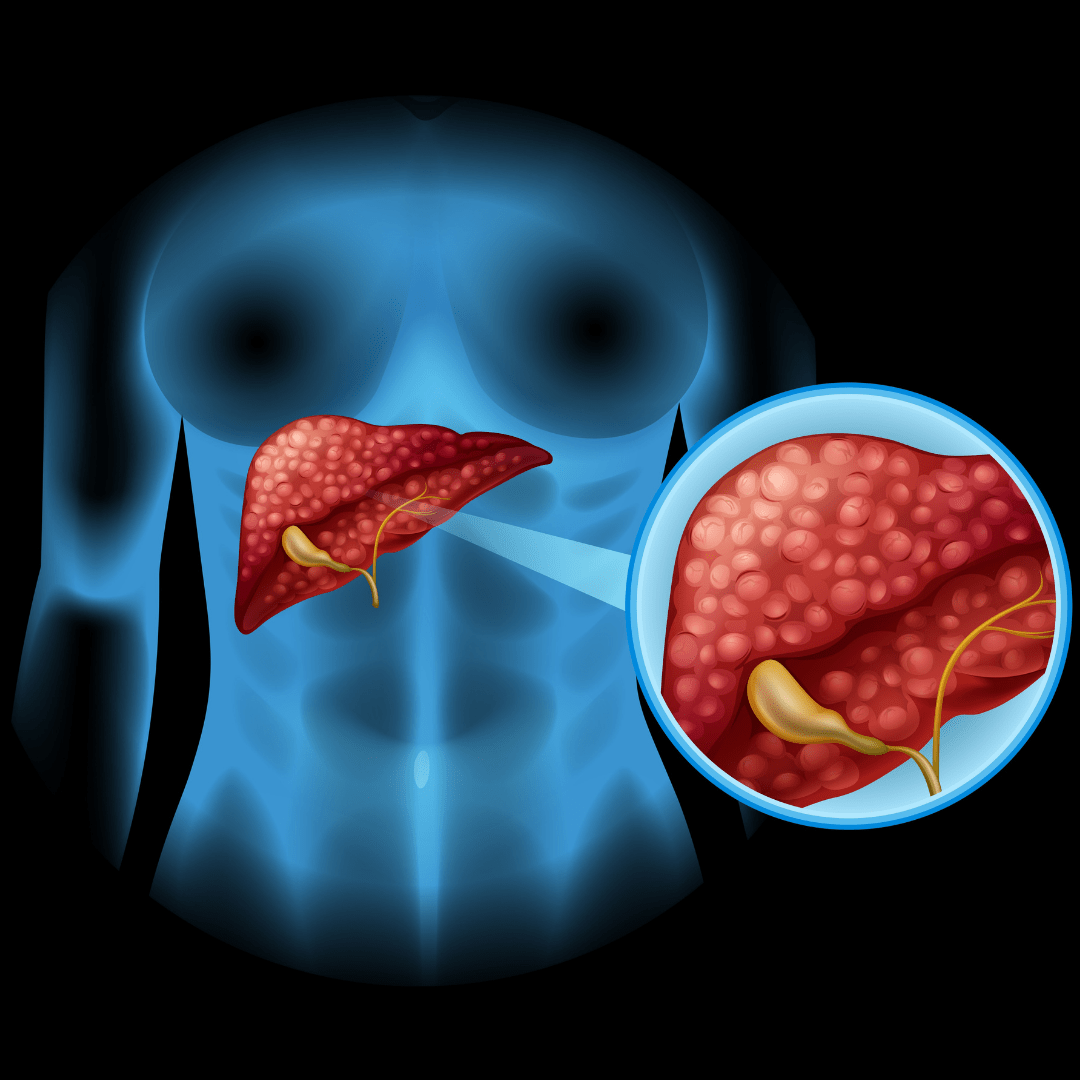 肝纖維化掃描（Fibroscan）